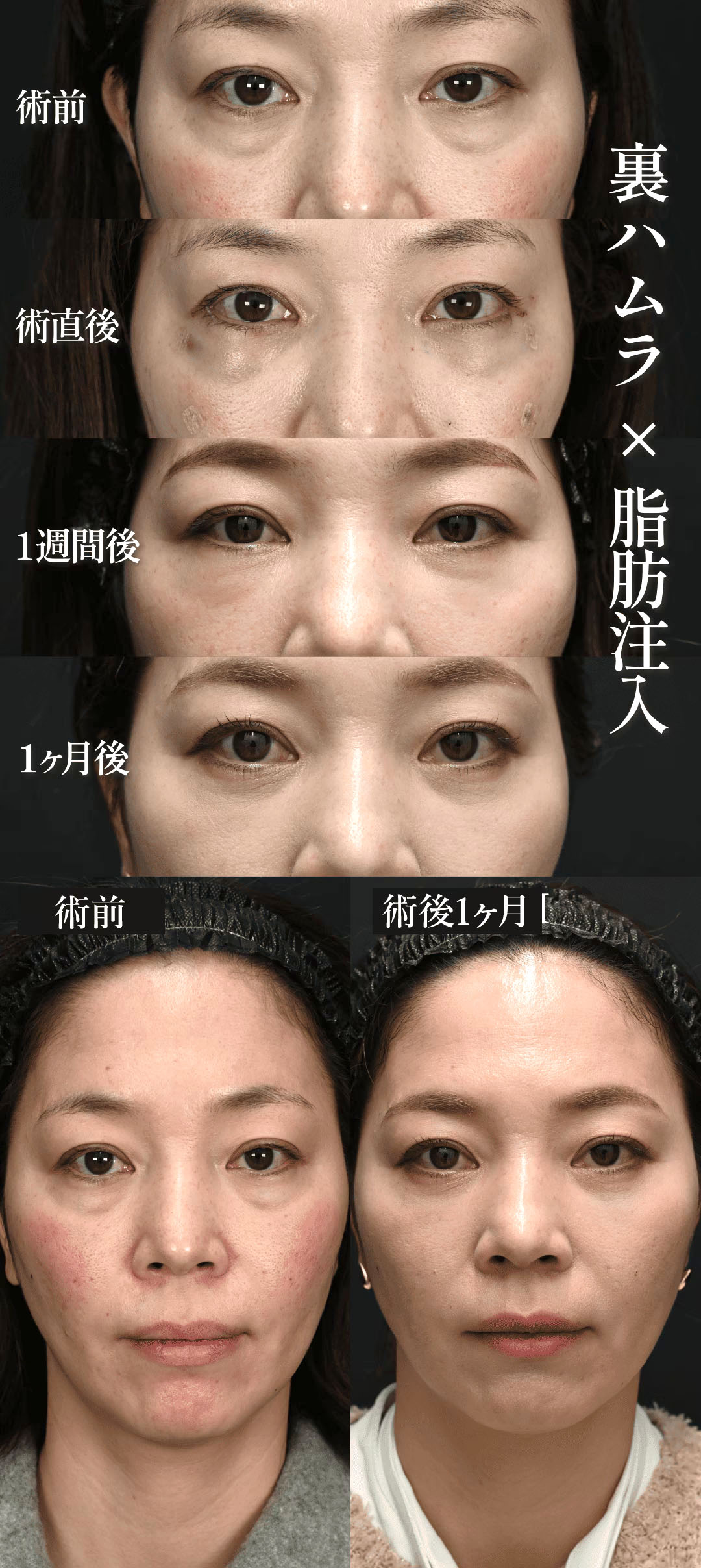 中野医師による裏ハムラ法症例