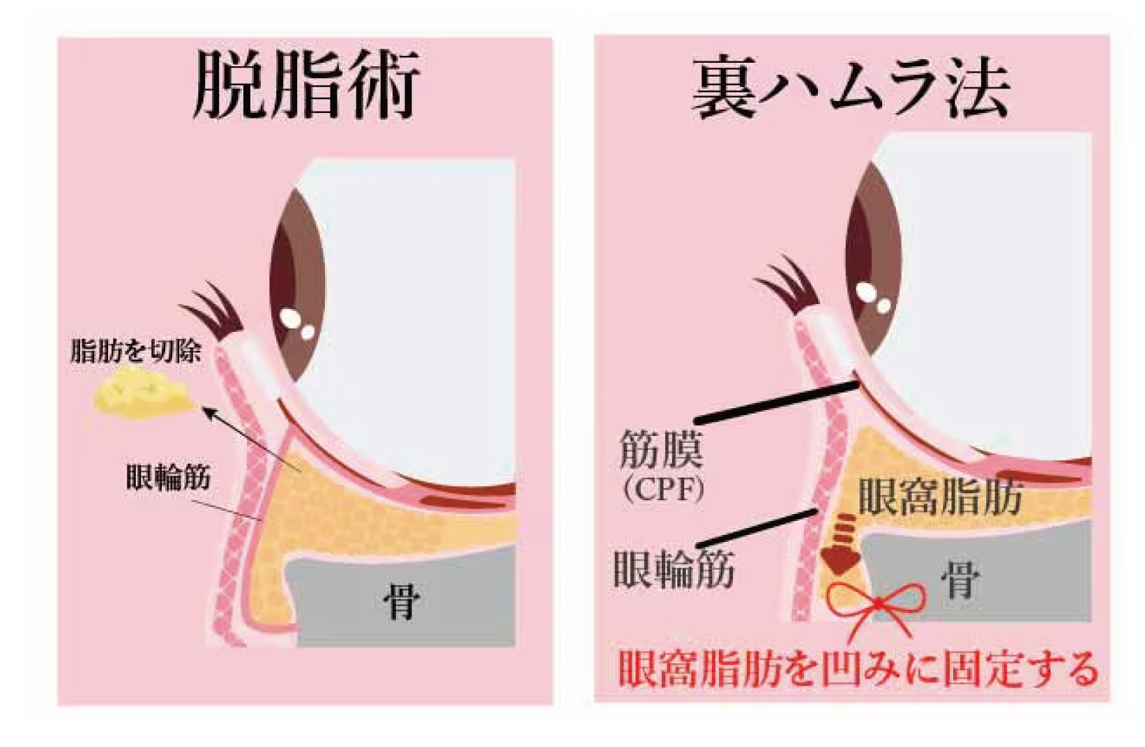 膨らみの原因を根本治療できるクマ取りについて
