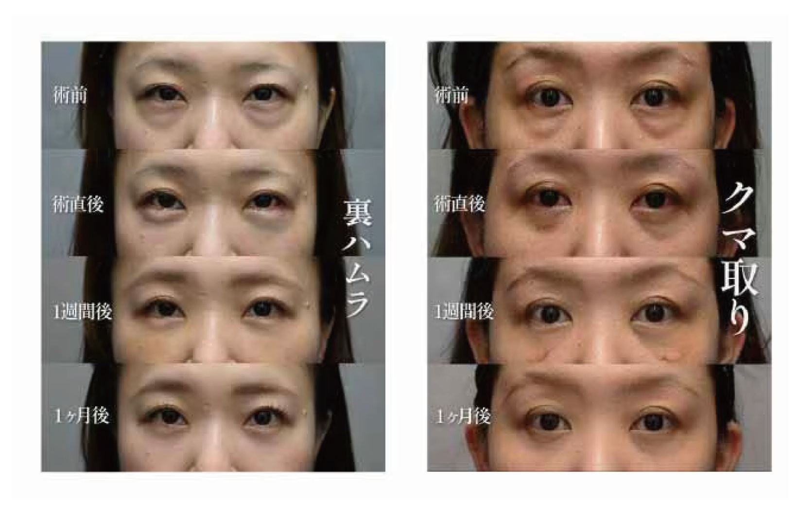 裏ハムラ法・脱脂術を施術したお客様のダウンタイム