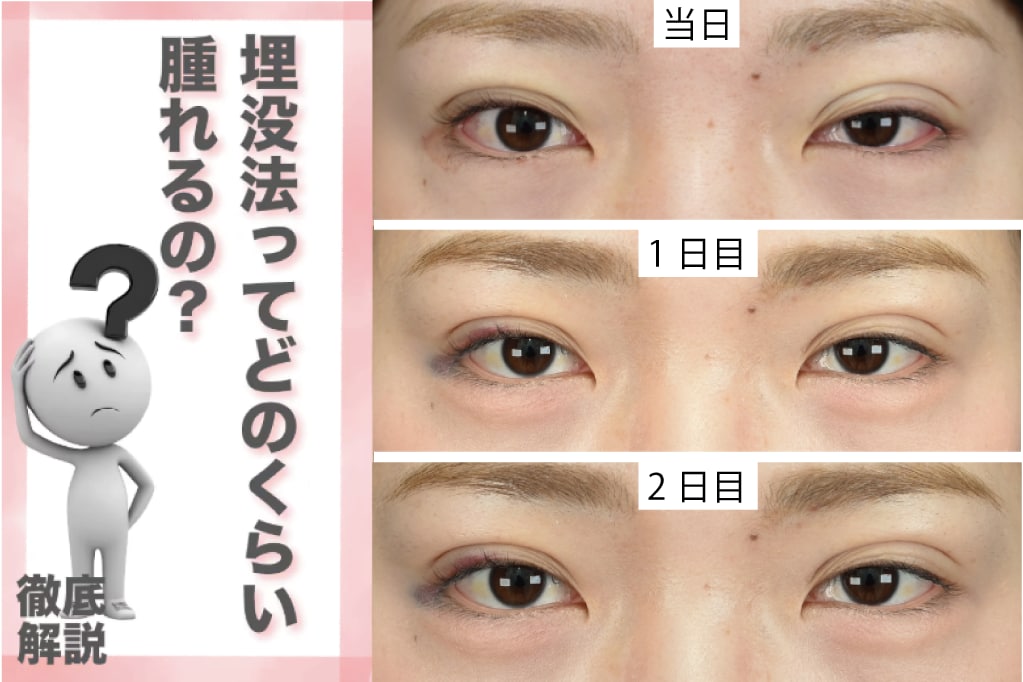 埋没法の腫れは何日続く?ダウンタイムの経過・早く治す方法を徹底解説