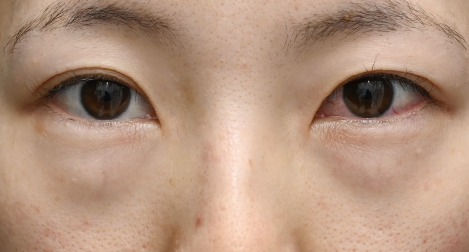 【究極の若返り】中野式 裏ハムラ法 × ナチュラル脂肪注射