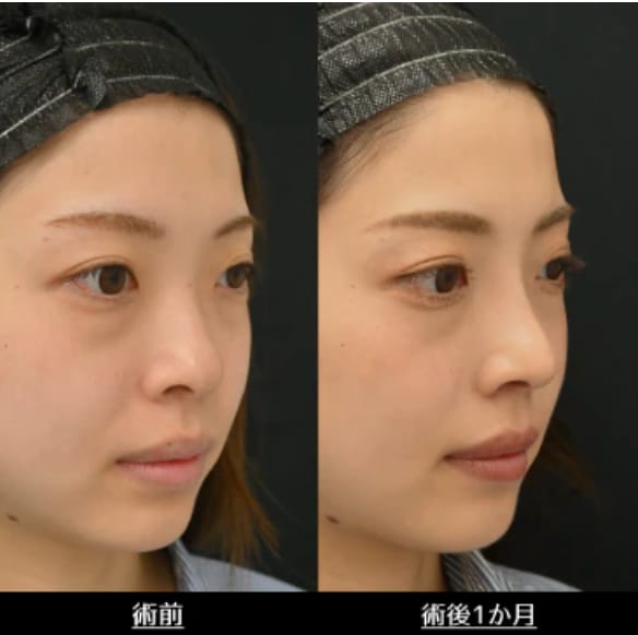 ソフトプロテーゼ(I型)/鼻尖形成術3D法/鼻尖部軟骨移植/小鼻縮小術(フラップ法)