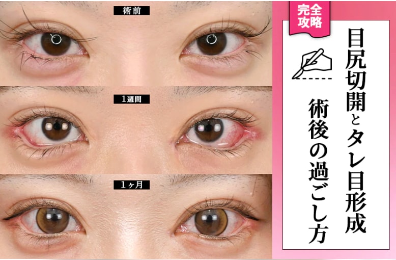 【自然にデカ目✨】目尻切開やタレ目形成のダウンタイムは?術後の経過とダウンタイムを最小限にする方法を解説