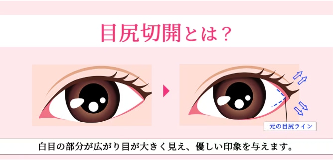 目尻切開法とは？
