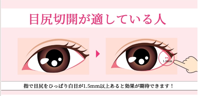 目尻切開が適している人の特徴