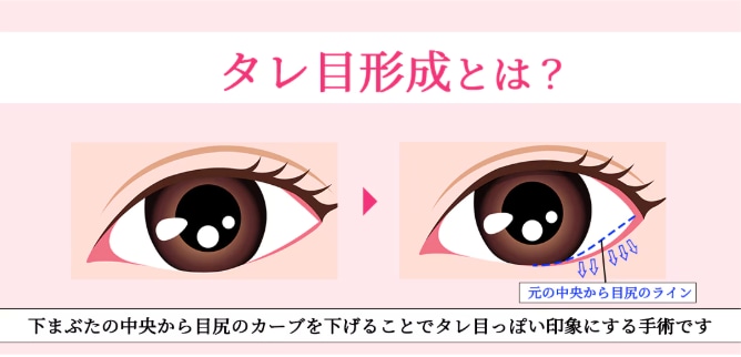 タレ目形成(下眼瞼下制)とは？