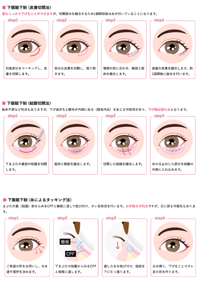 タレ目形成には3つの施術方法があります