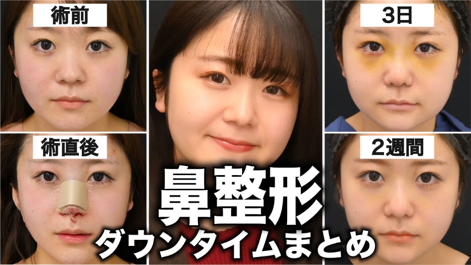 鼻整形のダウンタイムは?症状や過ごし方、仕事復帰のタイミングを症例を元に解説!