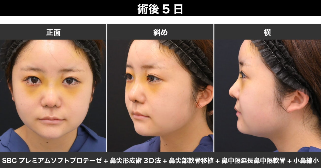術後5日目