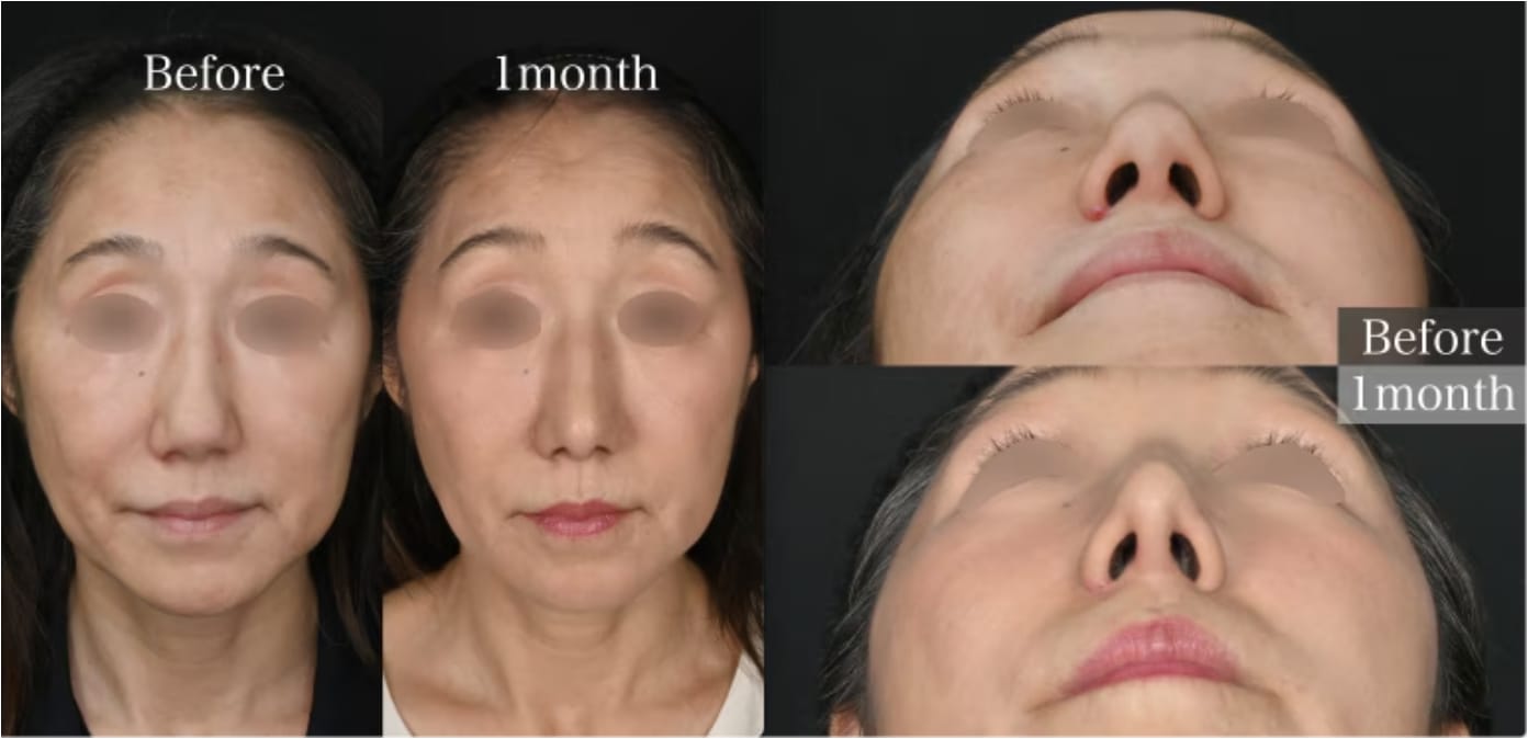 50代の鼻整形