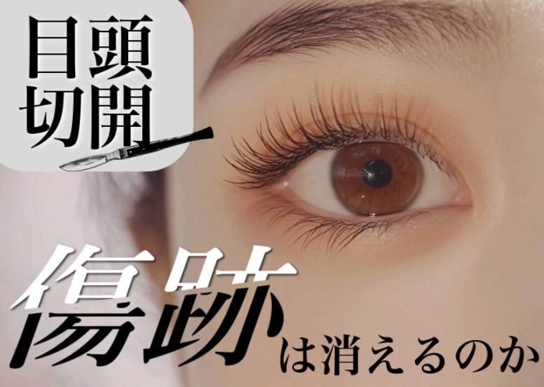 目頭切開の傷跡はどれくらい目立つの?治療の種類と経過を見ながらあなたの不安を解消します!