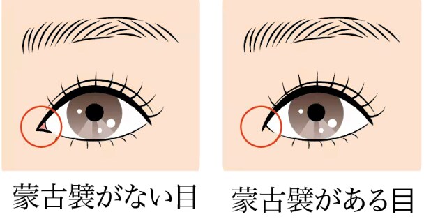 目頭切開とは