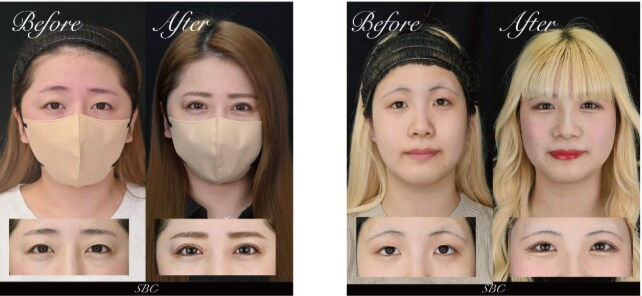 <b>プレミアムドクターの中野医師が作る埋没法</b>