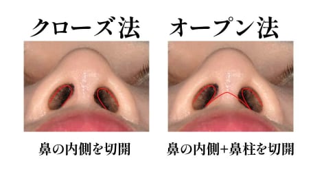 傷跡や感染を極力抑える