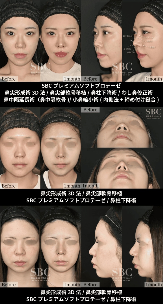 SBCにて全国No.1鼻整形症例数を誇る中野医師の鼻整形をご紹介！