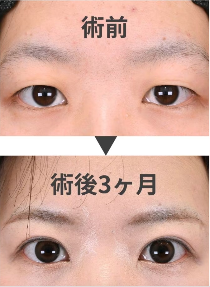 タルミ取り併用全切開法二重術とは