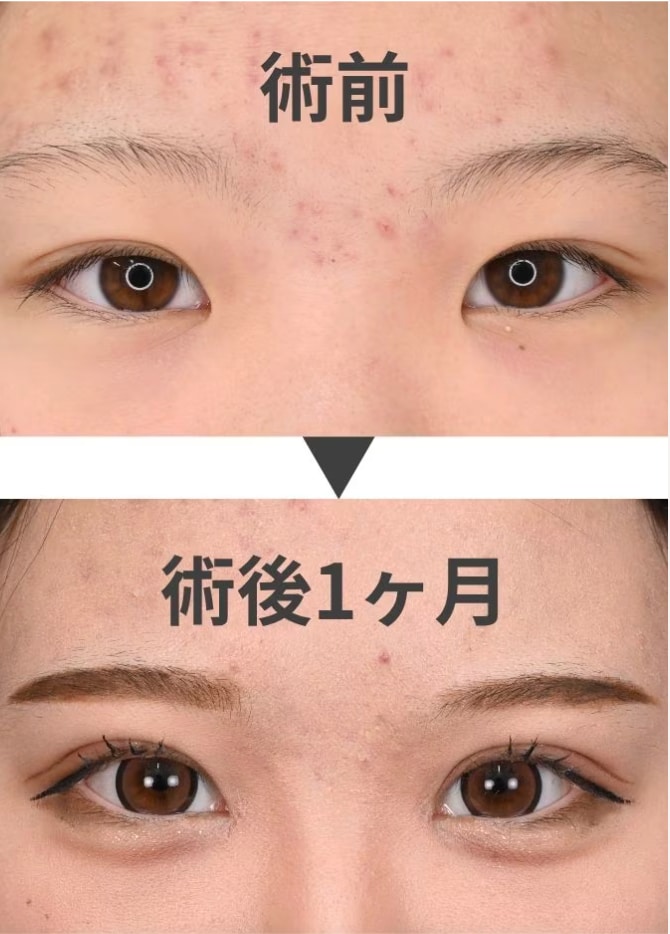 目頭切開とは