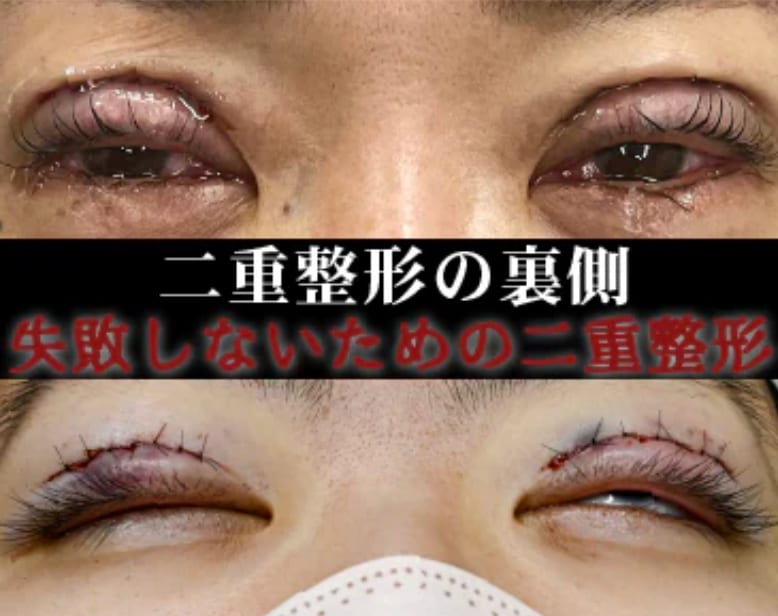二重整形で失敗しないための完全ガイド!知らないと後悔する重要ポイント解説