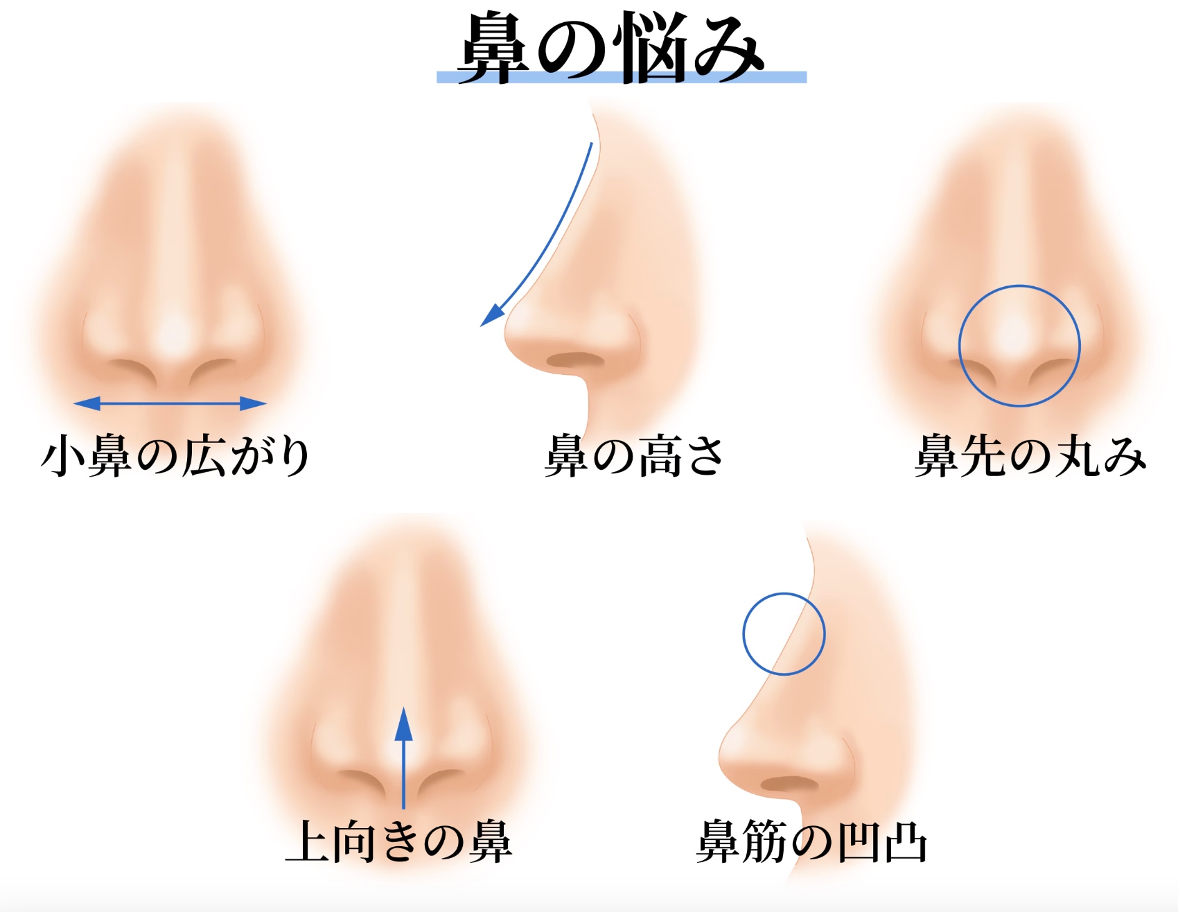 ここ治したい！とよく相談される鼻のお悩みランキング