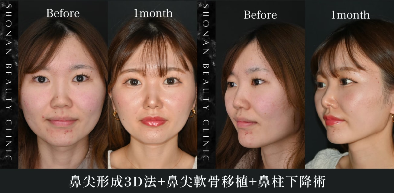 埋まっている鼻柱を出す-鼻柱下降術-