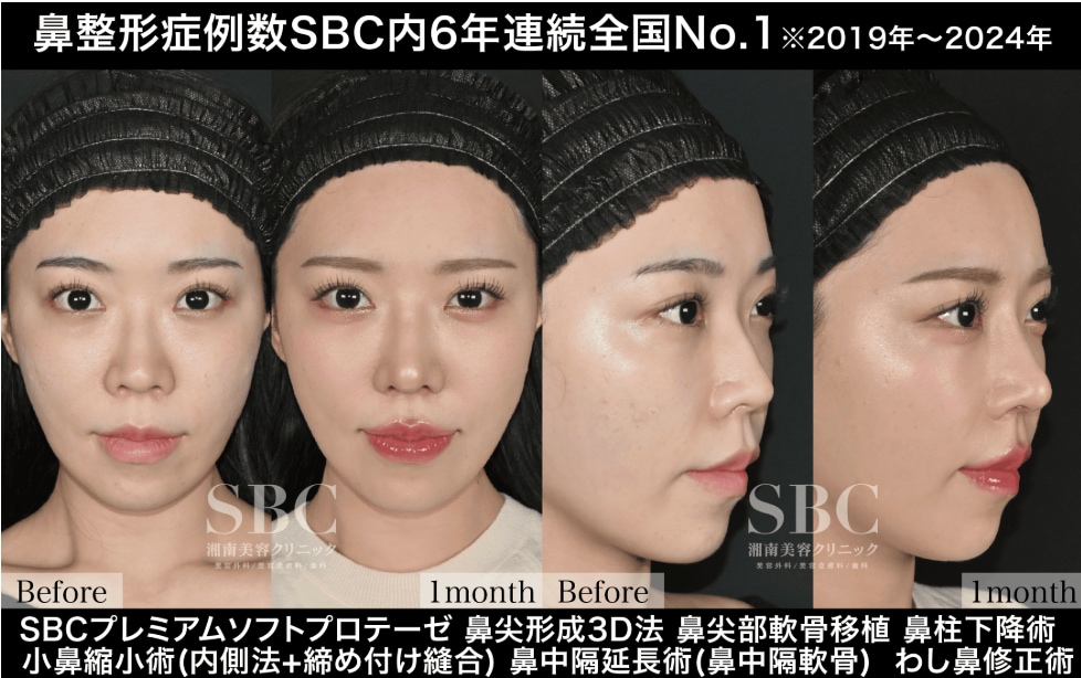1度で鼻整形の治療を複数受けること！