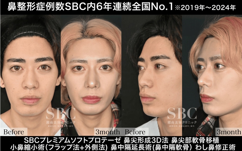 男性も垢抜けるメンズ鼻フル整形