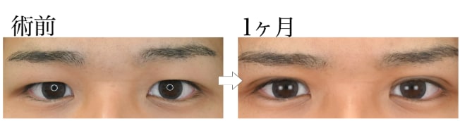 【男子高校生】目元がスッキリし垢抜け成功！