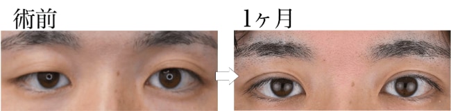 【20代男性】左右差のある目元を改善！理想通りの目元に