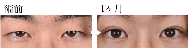 【10代男性】一重から別人級に変化！