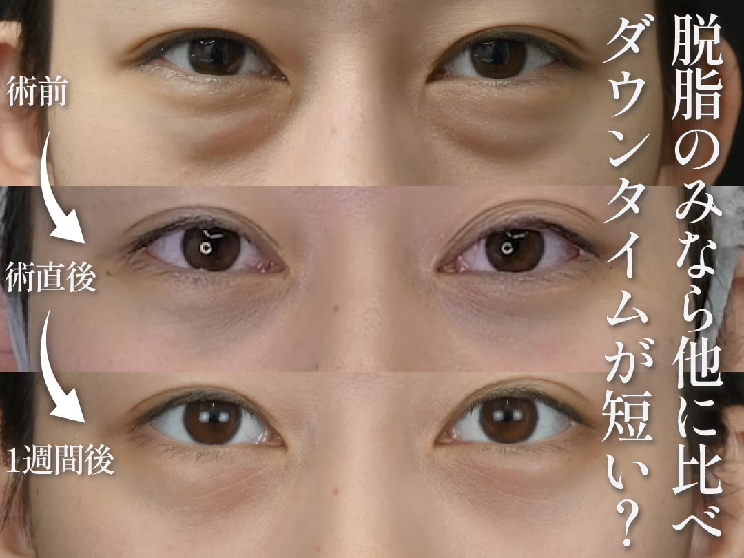 【クマ取りダウンタイム】脱脂術ならダウンタイムが短い！他の治療との違いと治療後の過ごし方をご紹介！
