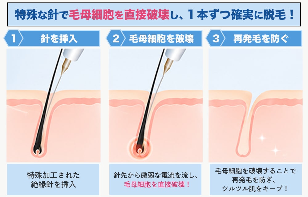 ニードル脱毛とは