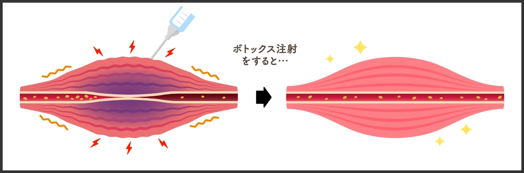 ボトックスって何？