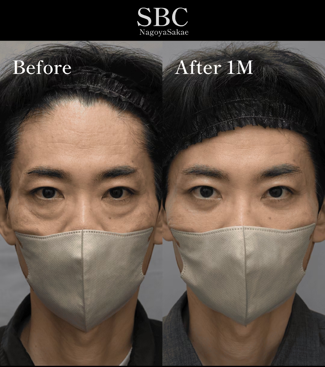 裏ハムラと同時に行うミッドフェイスリフトで中顔面全体を若返らせる技術