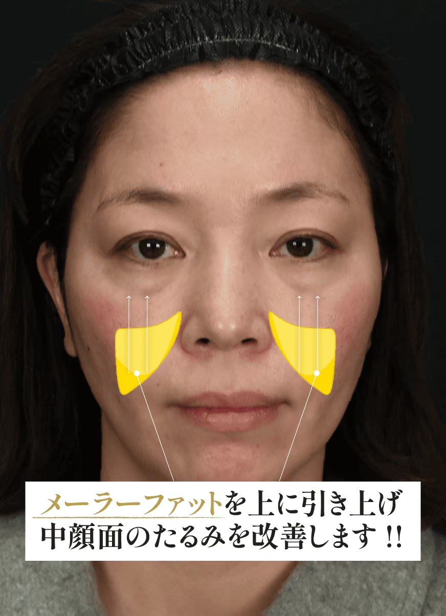 頬の脂肪（メーラファット)をリフトアップする治療です！