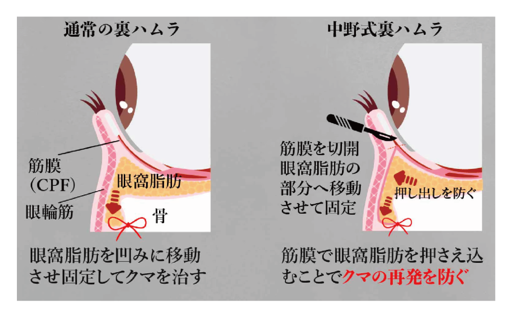 独自に工夫した裏ハムラ法