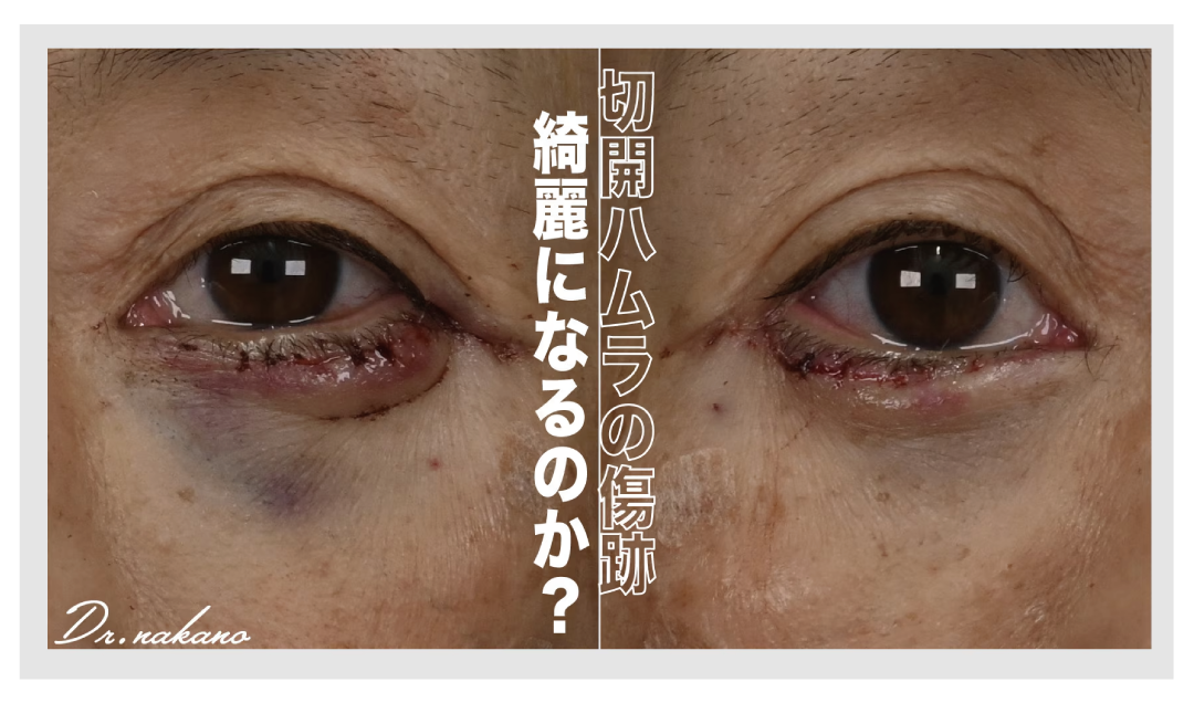 切開ハムラ法の傷跡は綺麗になるのか?ダウンタイムをもとに解説しあなたの不安を解消させます!
