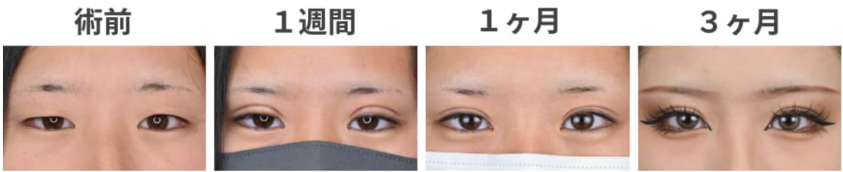 切開法の場合