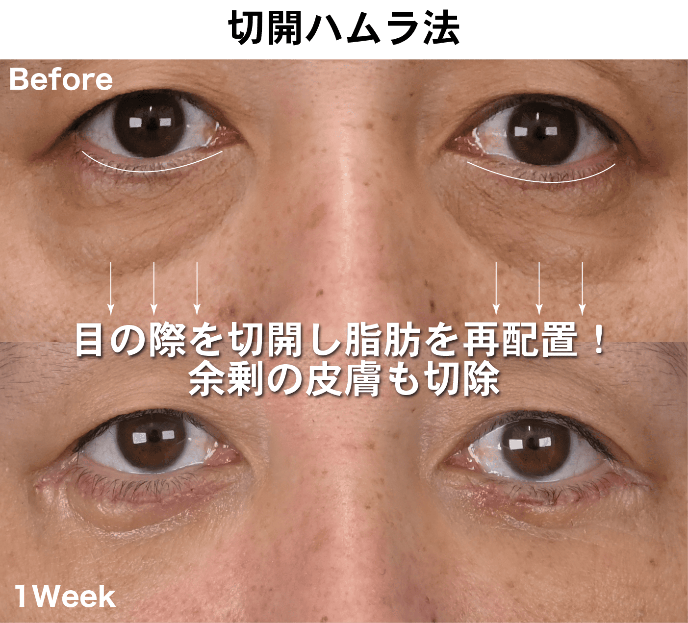表ハムラ法（切開ハムラ法）