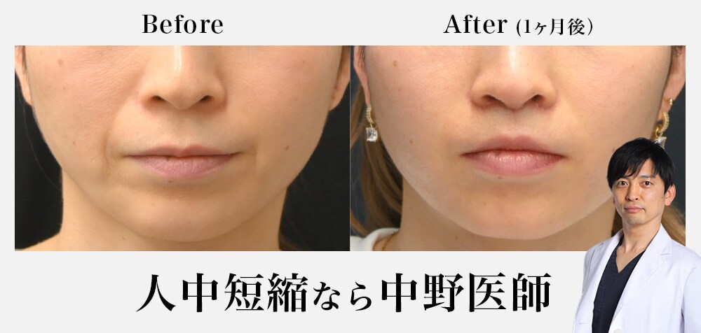 鼻の下の間延び感を自然に改善！
