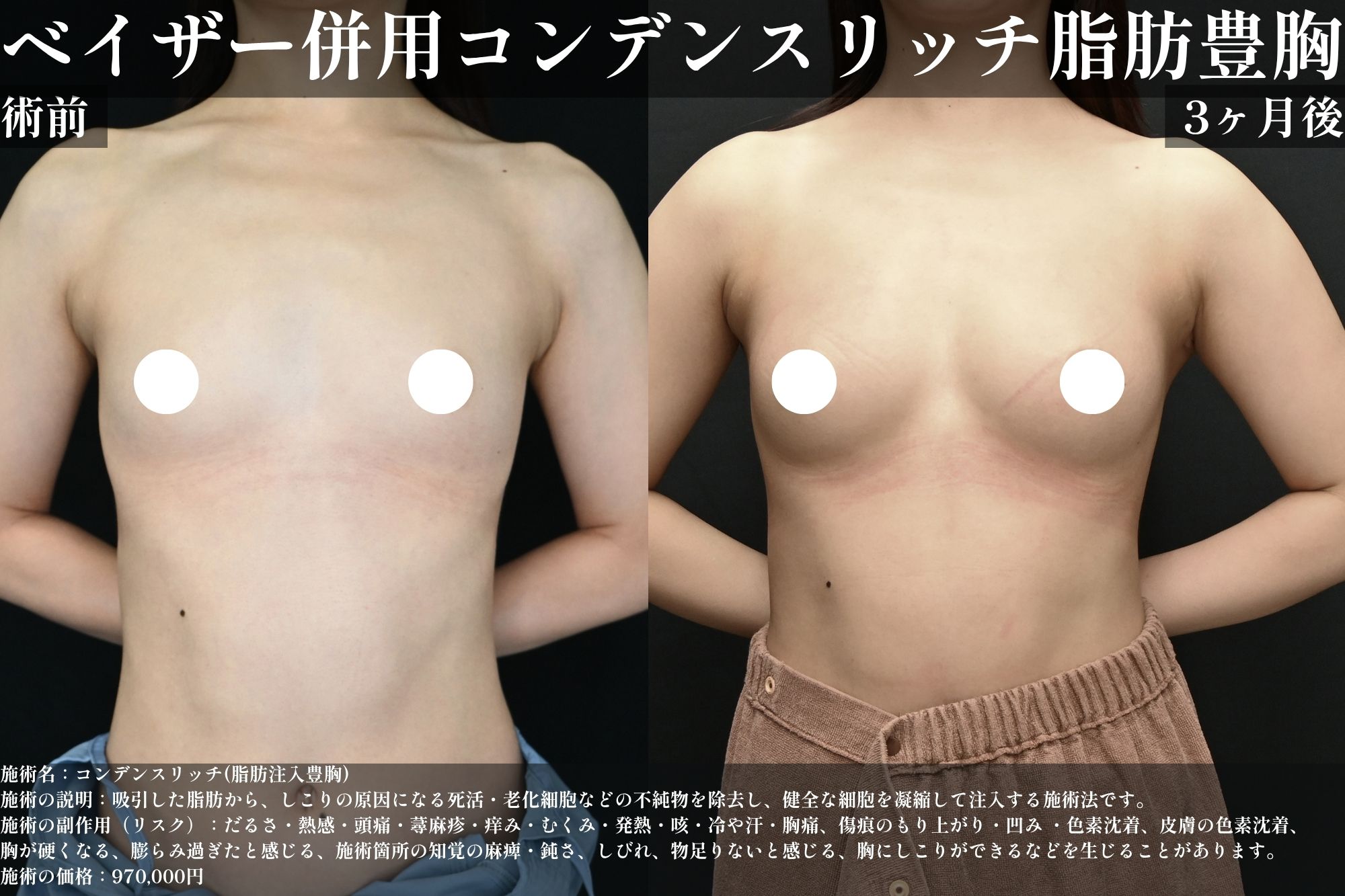 ベイザー併用コンデンスリッチ脂肪注入豊胸
