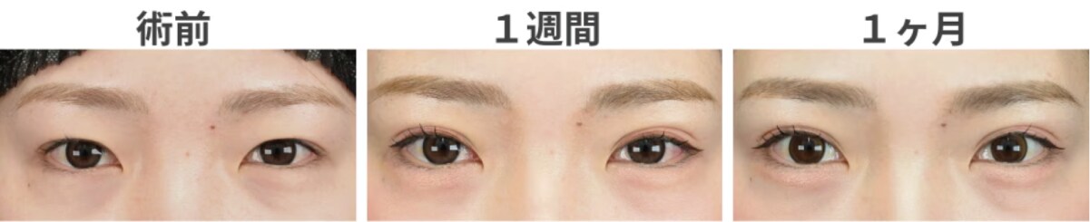 埋没法の場合
