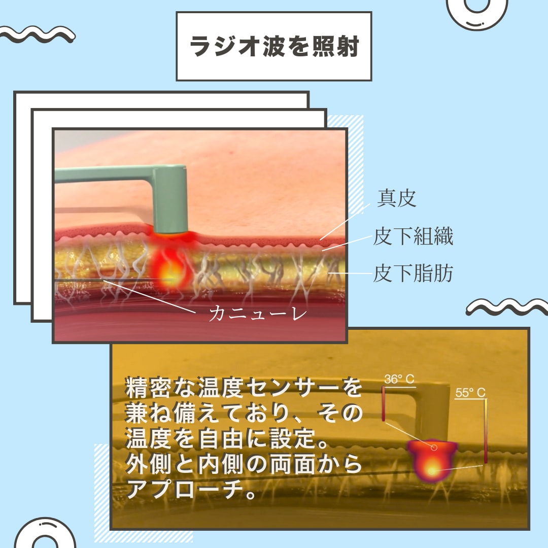 強力引き締めLテクノロジー