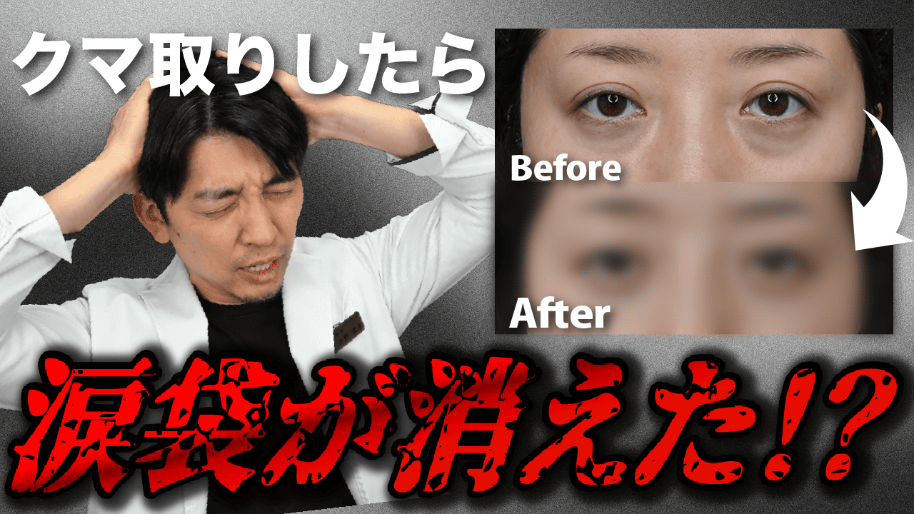クマ取りで涙袋が消える?消えるのが不安で行動出来ないという方真実をお伝えします!