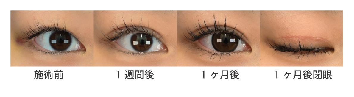 切開法