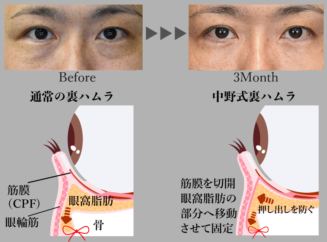 筋膜で脂肪を抑え込みより再発を防ぐ