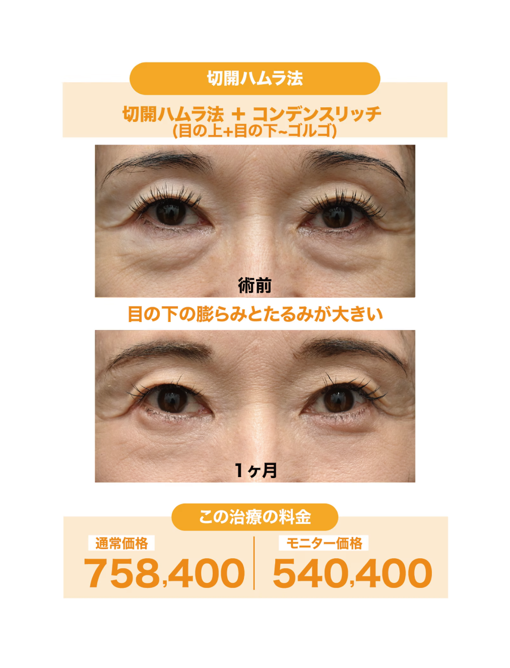 60代女性:切開ハムラ法＋ナチュラル脂肪注射（コンデンスリッチ）