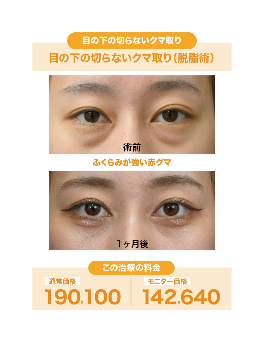 20代女性:目の下の切らないクマ取り(脱脂術)