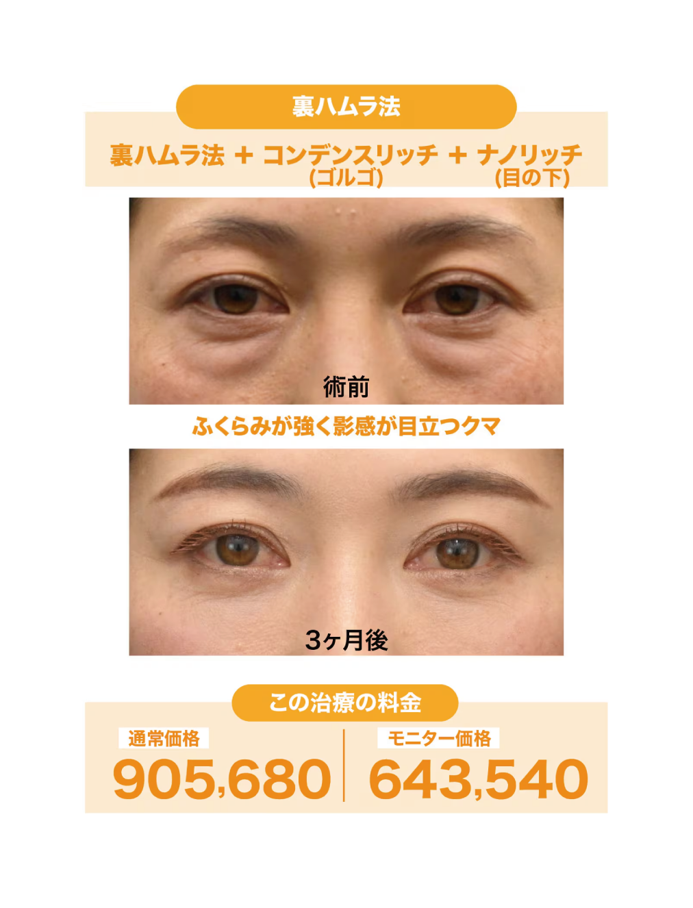 40代女性：裏ハムラ法＋ナチュラル脂肪注射（コンデンスリッチ・ナノリッチ）
