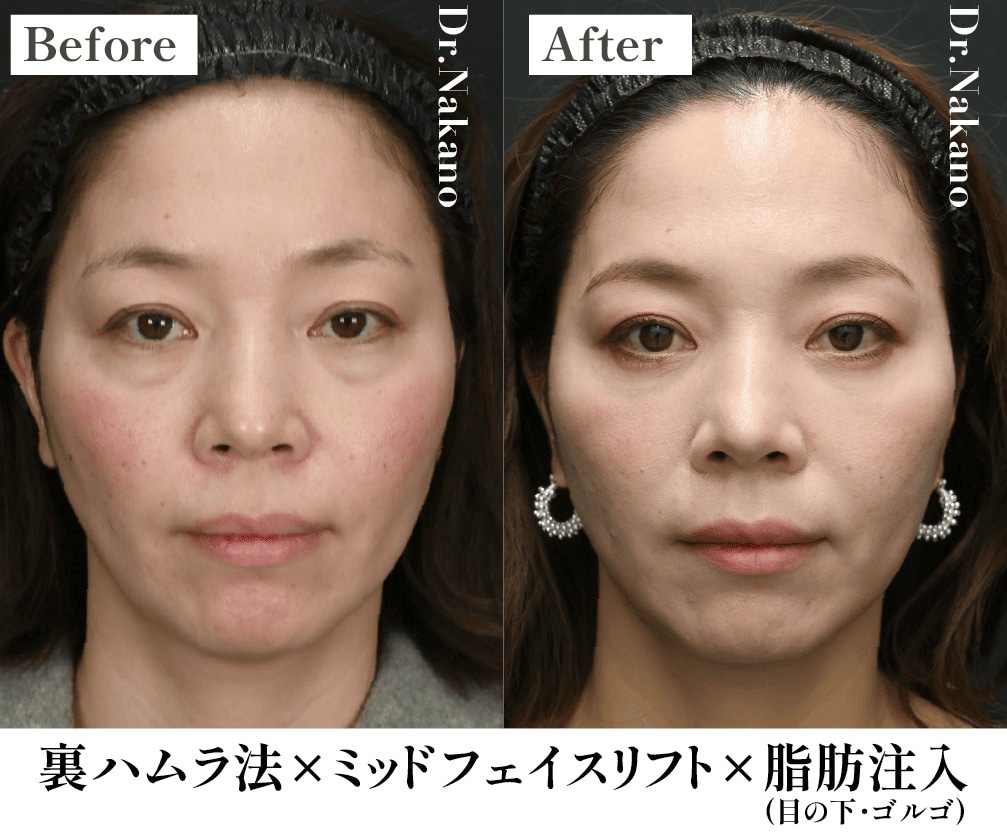 裏ハムラ法と同時に行うことで相乗効果が高い！