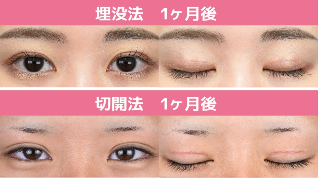 夏休みの二重整形の具体的な術式と特徴